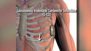 New SICD defibrillator a safety net for cardiac patients [upl. by Nino562]