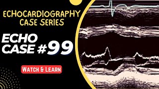 ECHO CASE 99  Echocardiography for Beginners  M Mode Echocardiogram [upl. by Marris]