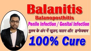 Balanitis  How to Cure Balanitis  पुरुष के अंग में सूजन जलन और इन्फेक्शन का इलाज [upl. by Aubert]