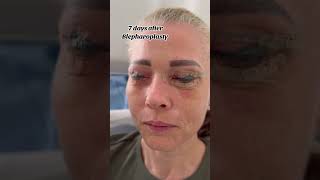 7 days after Blepharoplasty upper amp lower eyelid surgery  What do you think about this video [upl. by Mariquilla854]