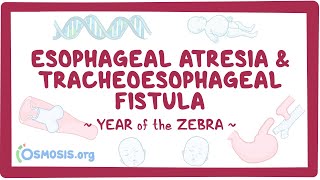 Esophageal atresia amp tracheoesophageal fistula Year of the Zebra [upl. by Shurlock]