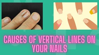 Causes Of Vertical Lines On Your Nails and What to Do About It  Nuse Healthy [upl. by Weihs]