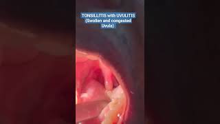 The ULTIMATE VIEW of TONSILLITIS with UVULITIS Watch Now shorts short viral trending [upl. by Rutledge]