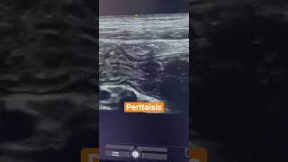 Peristalsis radiology ultrasound sonography ultrasonography [upl. by Jola321]