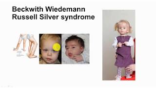 73 Imprinting part 2 Beckwith Wiedemann and Russell Silver syndrome [upl. by Edas]