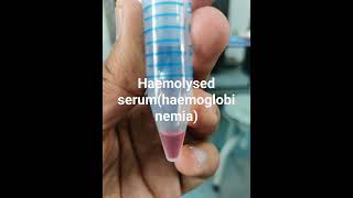 Haemoglobinemia indicative of haemolysis [upl. by Anatnas102]