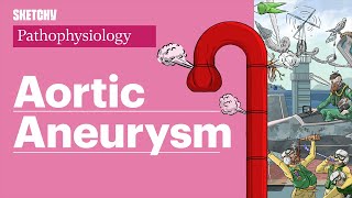 Aortic Aneurysms Pathophysiology amp Risk Factors Part 1  Sketchy Medical  USMLE Step 1 [upl. by Giorgio]