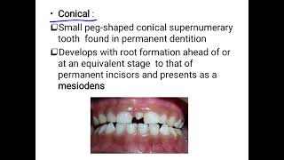 supernumerary teeth [upl. by Berriman]