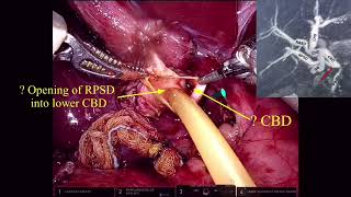 Robotic Hepaticojejunostomy HJ with Ductoplasty with aid of ICG for a case of Choledochal Cyst [upl. by Ochs]