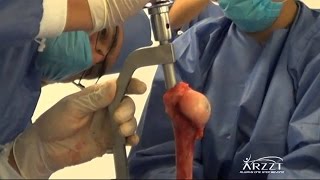 Removal of a tibial intramedullary nail [upl. by Silin]