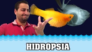 🔵Hidropsia ou barriga dagua o que é e as Opções de tratamento [upl. by Shellans614]