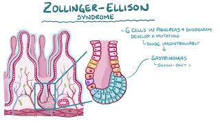 zollinger Ellison syndrome [upl. by Kenn488]