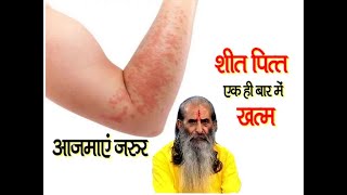 शीत पित्त का आयुर्वेदिक घरेलू इलाज  Ayurvedic Home Remedies For Urticaria  swasth vichar [upl. by Drusie]