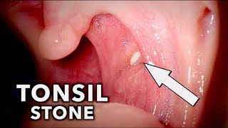 Tonsil Stones What Are They Tonsilloliths [upl. by Nerual]