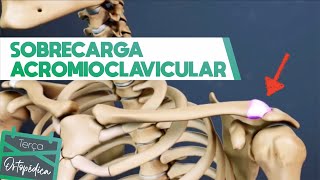 Sobrecarga Acromioclavicular Dr Eric Curi  Ortopedista Ombro e Cotovelo [upl. by Richer]