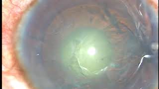 Corneal Topography assisted cataract surgery  Pradip Mohanta [upl. by Aldarcie368]