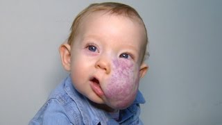 See 2YearOlds Incredible Transformation After Surgery To Remove Facial Tumor [upl. by Dulcea]