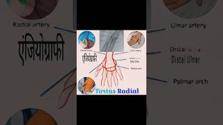 Tortous Radial Artery  रेडियल नसArteryका घुमावदार रास्ता😱😱😱कैसे पार किया देखें विडियो cathlab [upl. by Zielsdorf]