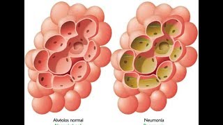 Neumonia  Fisiopatológia  Cuadro Clinico [upl. by O'Rourke]