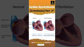 Cardiac Dysrhythmias Arrhythmia Part2  Types of Cardiac Arrhythmia Cardiac Dysrhythmias [upl. by Lucie]