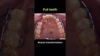 Braces change your teeth for better braces orthodontist dentist [upl. by Hartzke]