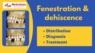 Fenestration and Dehiscence l Periodontal anatomy l Mediklaas [upl. by Dnaltroc]