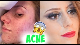 Como eu me livrei das ESPINHAS ACNE [upl. by Quill83]