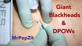 Large blackheads extracted DPOWs packed full of content expressed Spectrum of blackheads displayed [upl. by Danyette371]