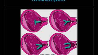 Obstetric US 6 Cervix [upl. by Ecinwahs]