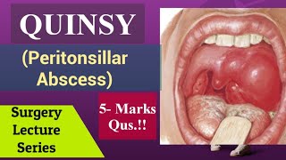 Peritonsillar AbscessQuinsy Surgery Lecture NEET PG Aspect in Tonsils Tonsillitis [upl. by Nitsruk164]