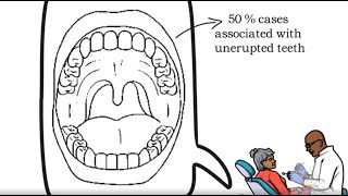 Calcifying Epithelial Odontogenic Tumor CEOT [upl. by Lolanthe]