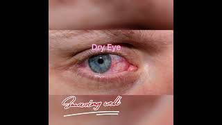 Dry Eye Prevention Tips [upl. by Diarmit]