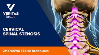 Cervical Spinal Stenosis [upl. by Mcnair525]