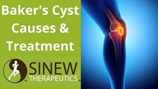 Bakers Cyst Causes and Treatment [upl. by Nabalas456]