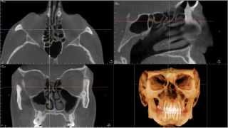 CBCT Interpretation Paranasal Sinuses Movie Sneak Peak [upl. by Elttil]