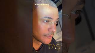 Chin Augmentation Neck Liposuction Rhinoplasty amp Hair Transplant by Dr TAS [upl. by Helbona493]