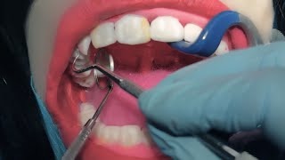 ASMR Dental Exam 🦷 Scaling amp Cavities  Dentist amp Patient POV [upl. by Nayk]