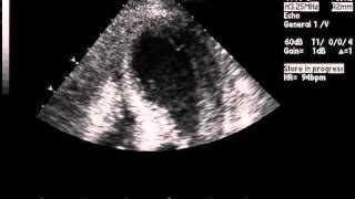 Transthoracic Echocardiogram Showing Akinesis on Apical FourChamber View [upl. by Yanaj393]