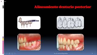 PRÓTESIS TOTAL ENFILADO o ARTICULADO DE DIENTES SUPERIORES [upl. by Hey428]