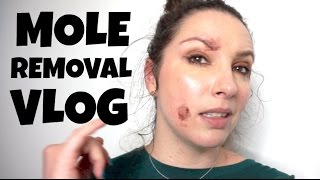 Mole Removal Vlog  Radiofrequency RF skin surgery before and after [upl. by Ronacin]