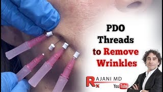 PDO Threads to Smooth Wrinkles [upl. by Ativet]