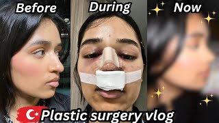 i got a rhinoplasty in TURKEY amp documented my entire recovery nose job vlog [upl. by Uda]