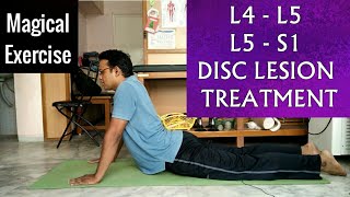 L 4L 5 amp L 5S 1 SLIPPED DISC Treatment  One EXERCISE To Cure LUMBER SLIPPED DISC completely [upl. by Eeclehc882]