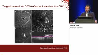 Treatment of myopic CNV Koh Adrian [upl. by Gosney]