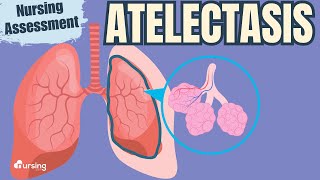 Atelectasis Pathophysiology and Nursing Assessment [upl. by Mirelle]