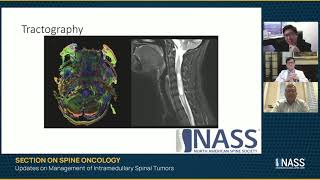 Updates on Management of Intramedullary Spinal Tumors [upl. by Fionna]