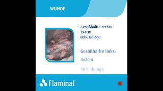 Fallbericht  Behandlung eines Dekubitus der Kategorie 3 mit Flaminal® [upl. by Montfort]