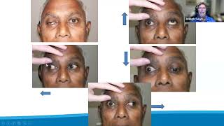 Doctor I See Doublequot Diagnosing and Managing Patients with Neurogenic Diplopia [upl. by Lebama]