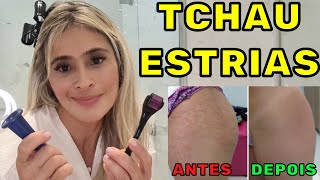 ELIMINE AS ESTRIAS EM SUA CASA – TRATAMENTO COMPLETO E EFICAZ ESTRIAS VERMELHAS ROXAS E BRANCAS [upl. by Ahsiakal]