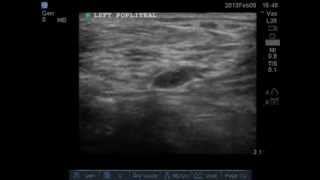 Ultrasound compression test for DVT Left Popliteal Vein Normal [upl. by Staffard]